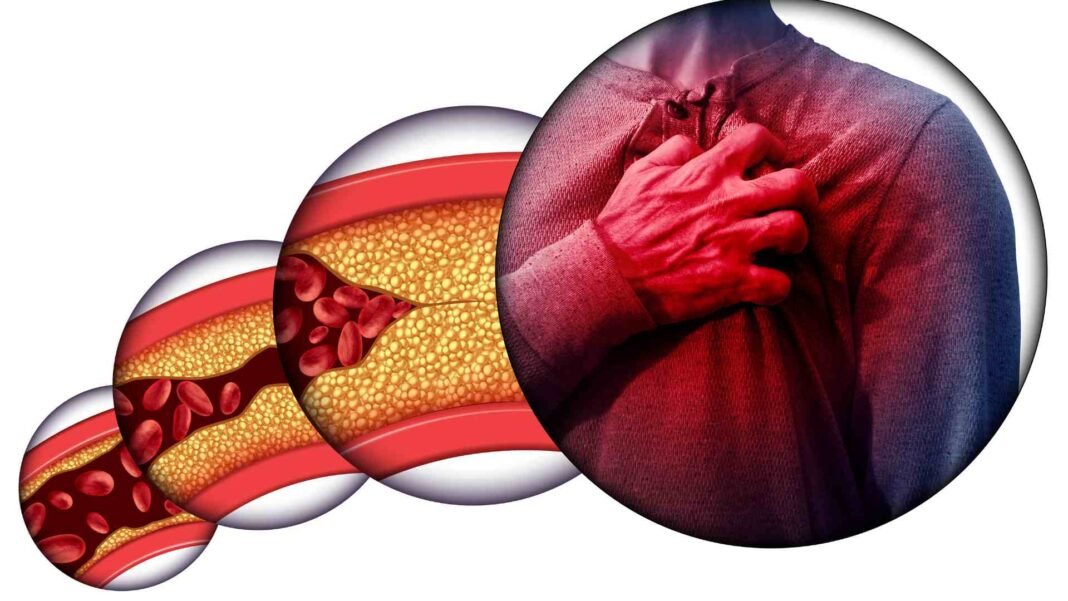 cardiovascular disease